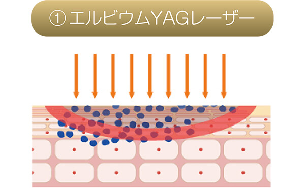 ①エルビウムYAGレーザー