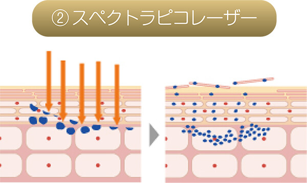 ②スペクトラピコレーザー